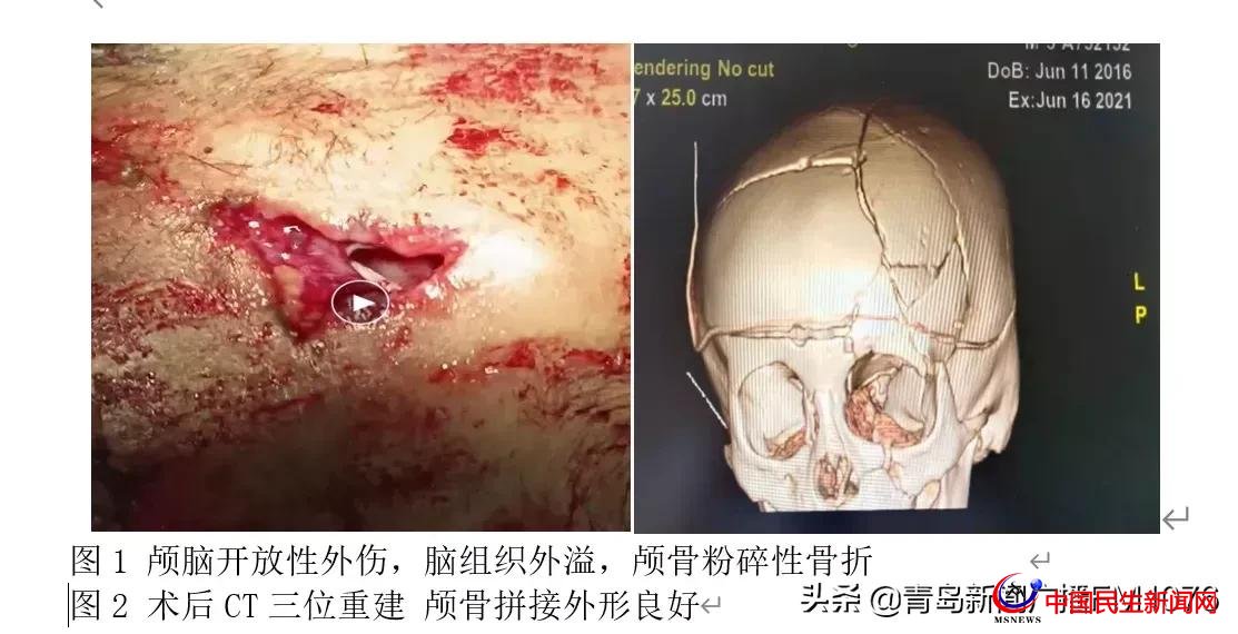 5歲男童6樓墜落命懸一線，婦兒醫(yī)院多學(xué)科協(xié)作再勝“死神”